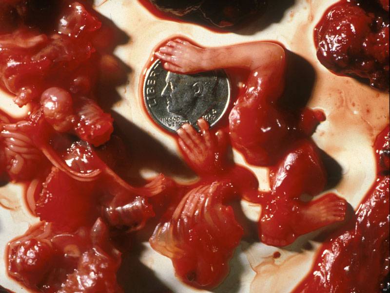 abortion10_weeks.jpg