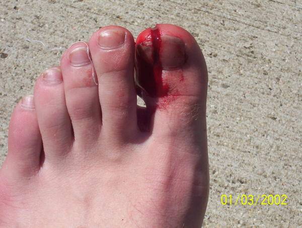 toe.jpg