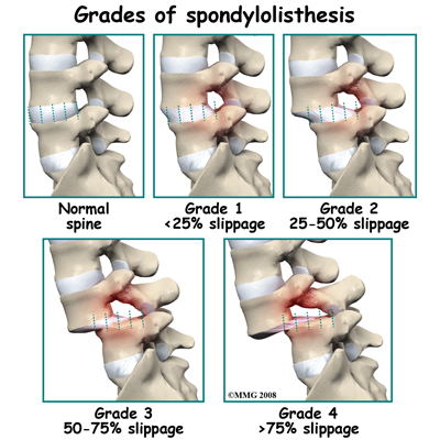 lumbar_spondylolisthesis_grades.jpg